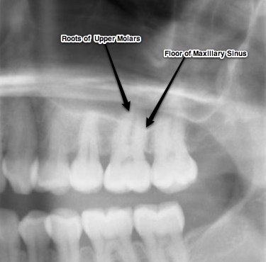 Headaches and Sinus Pain: Can a tooth be the culprit? - Philadelphia ...